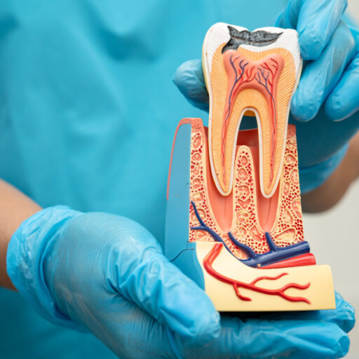 root canal therapy Toowong