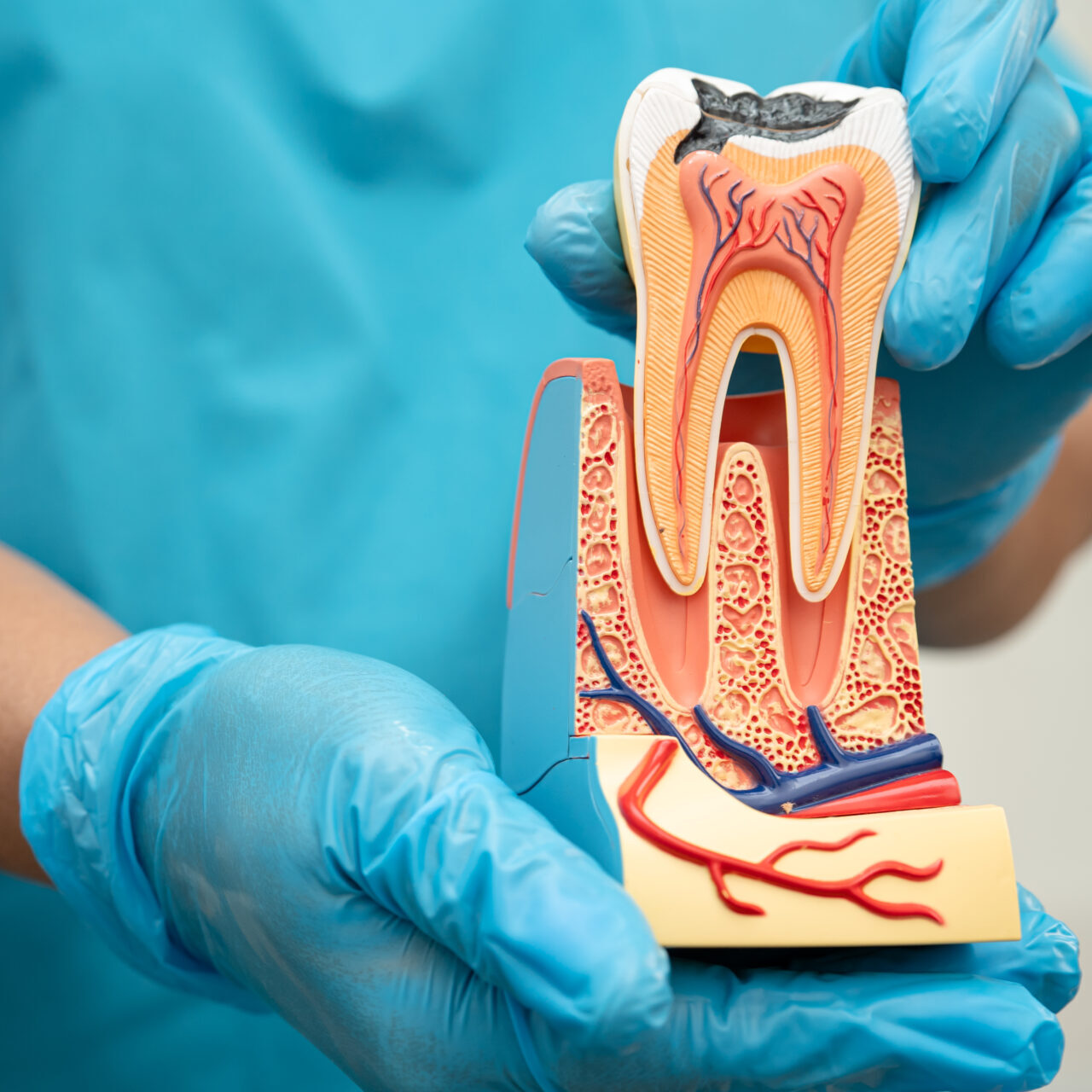 root canal therapy Toowong