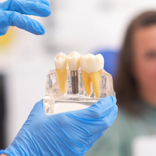 dental implants Toowong