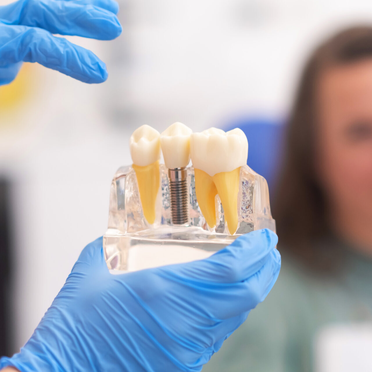 dental implants Toowong