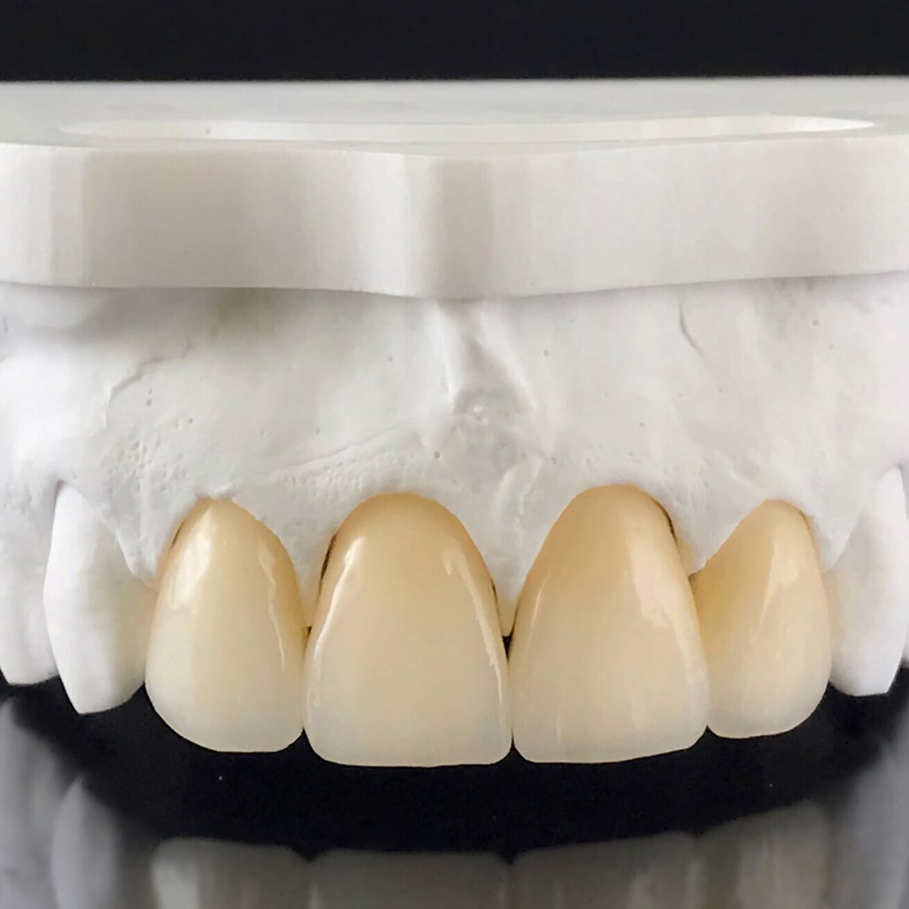 dental crowns toowong