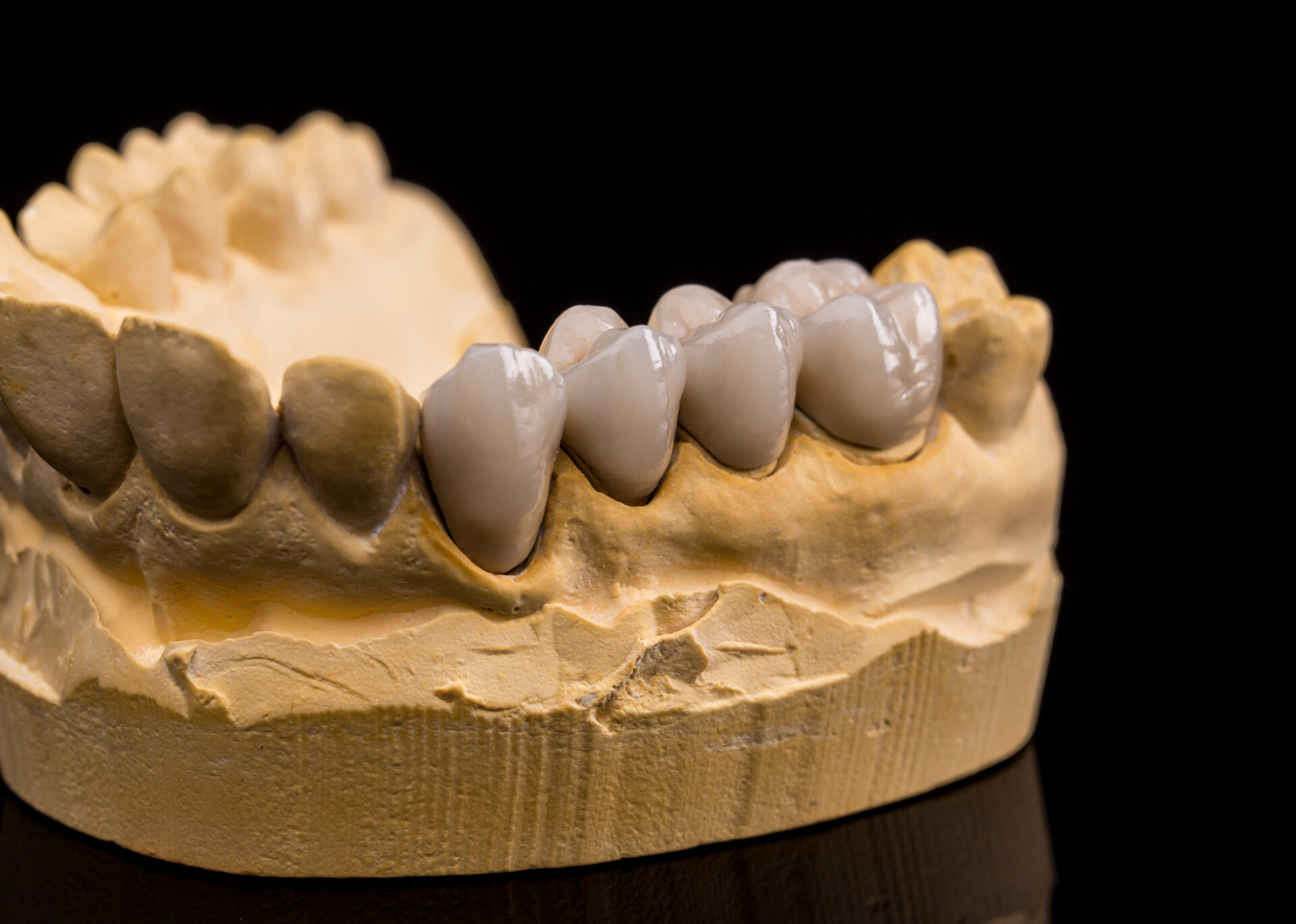 dental bridge toowong dental bridge toowong