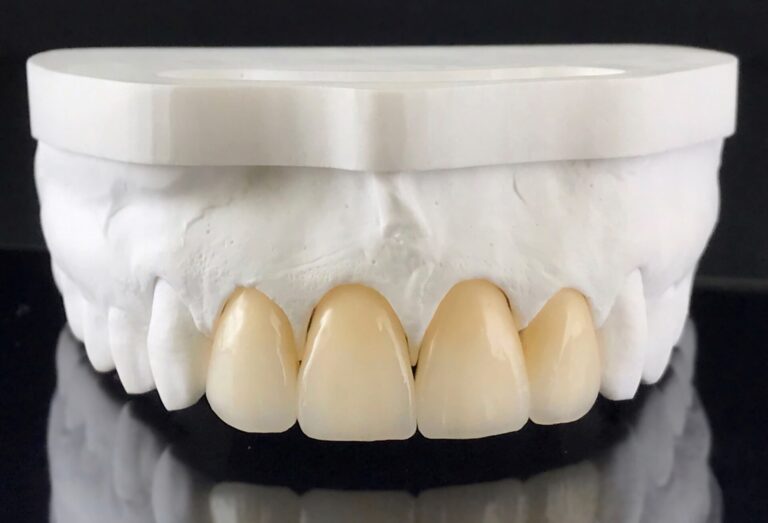 dental crowns toowong dental crowns toowong
