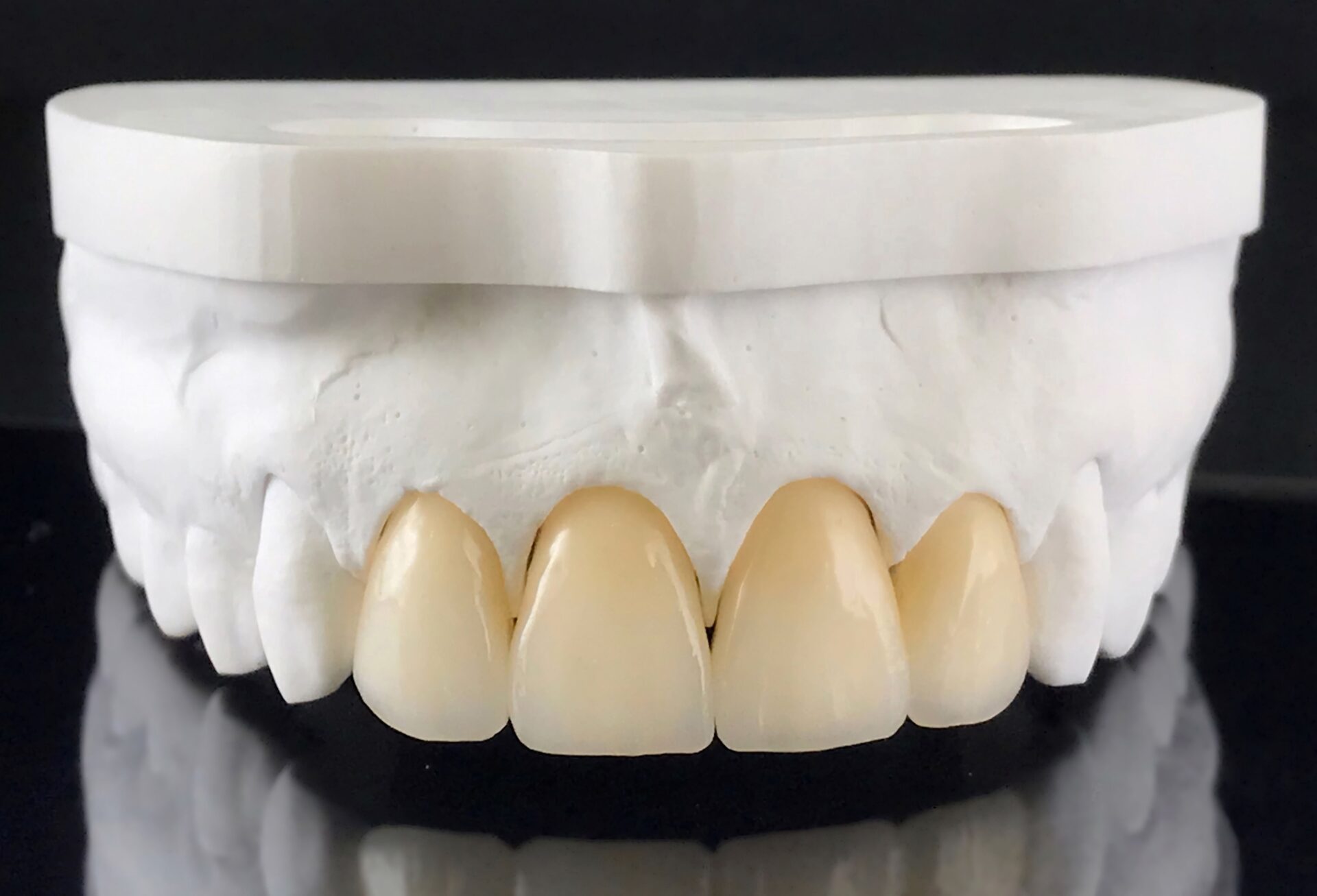 dental crowns toowong